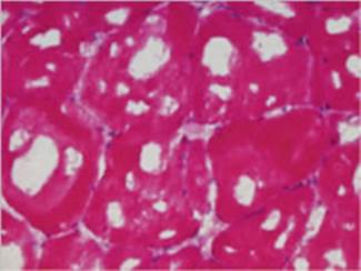 clin-ess-untreated